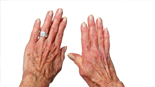 Arthritis